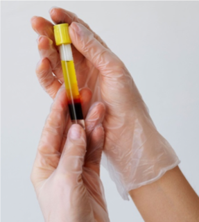 Plasma Rico en Plaquetas (PRP)